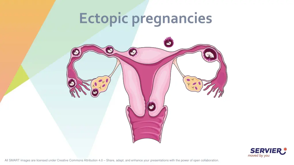 ectopic pregnancies