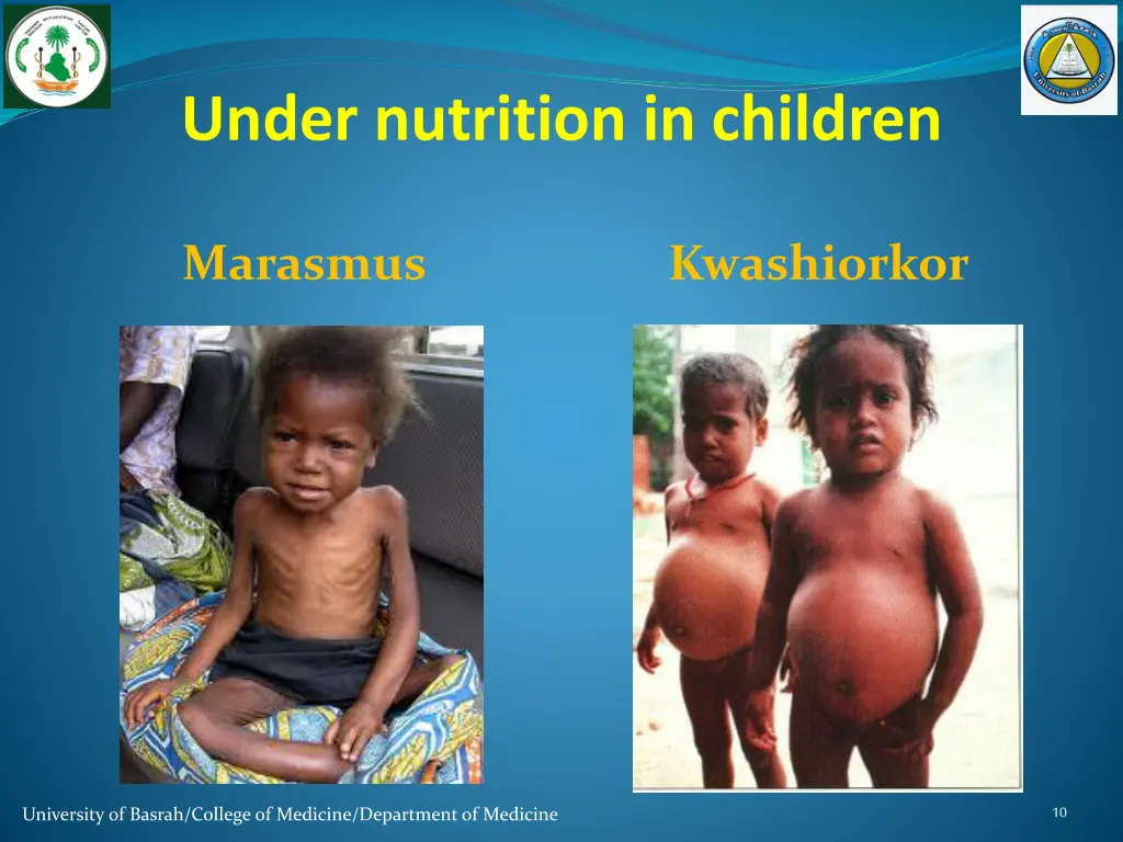 under nutrition in children