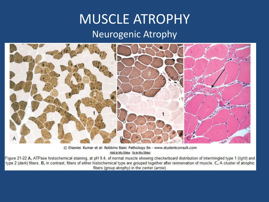 muscle atrophy neurogenic atrophy