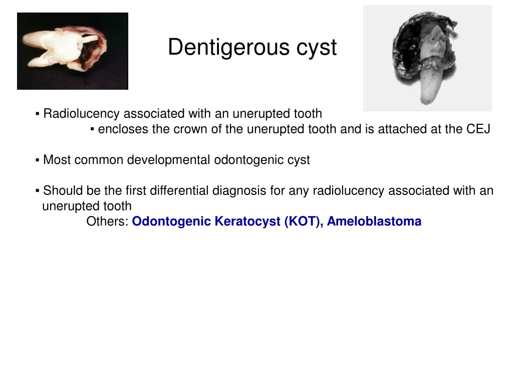 dentigerous cyst