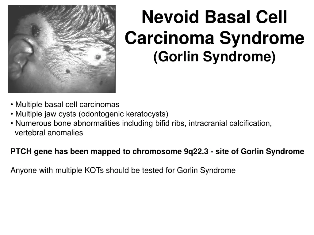 nevoid basal cell carcinoma syndrome gorlin