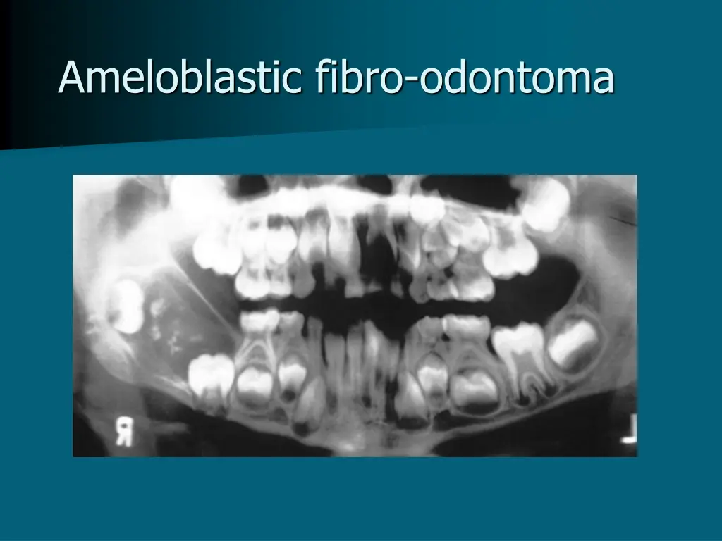 ameloblastic fibro odontoma