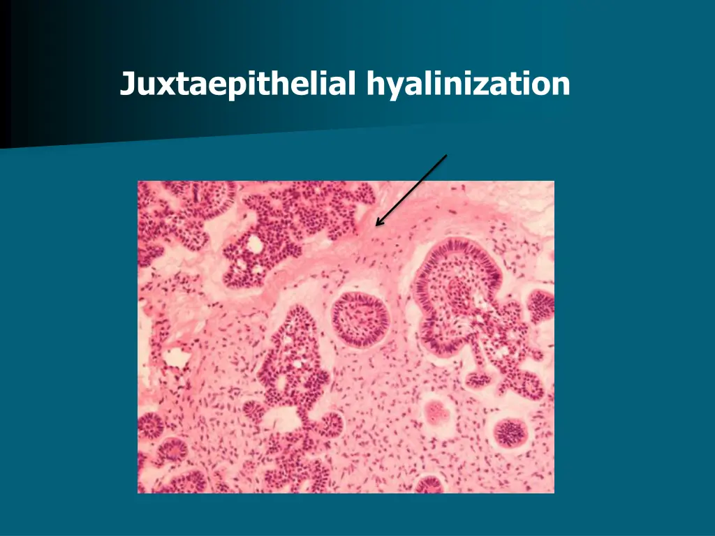 juxtaepithelial hyalinization