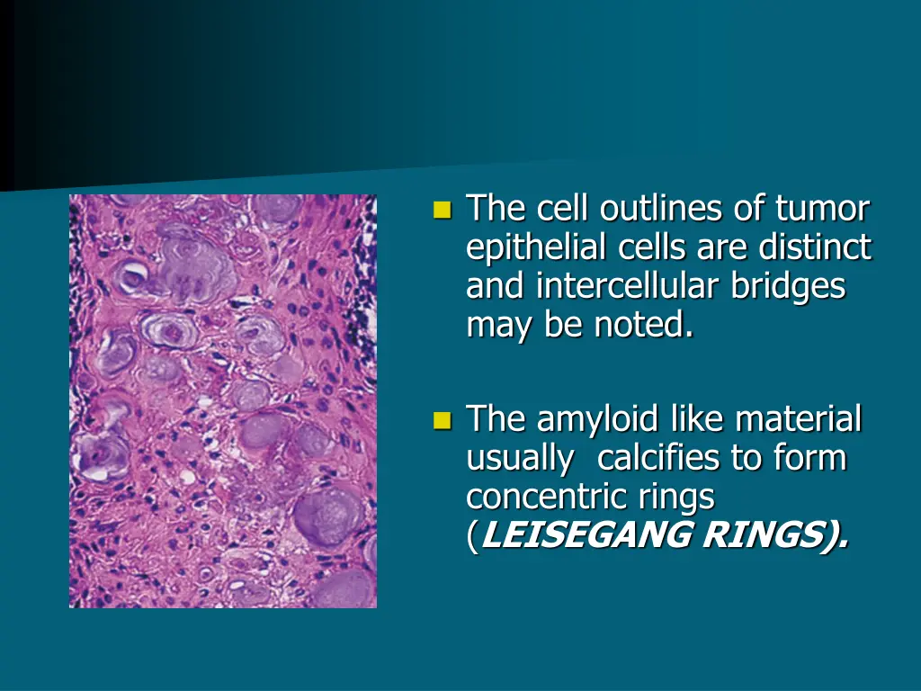 the cell outlines of tumor epithelial cells