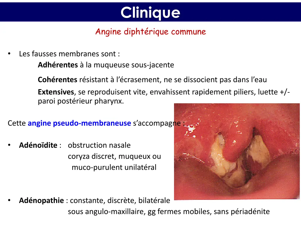 clinique angine dipht rique commune