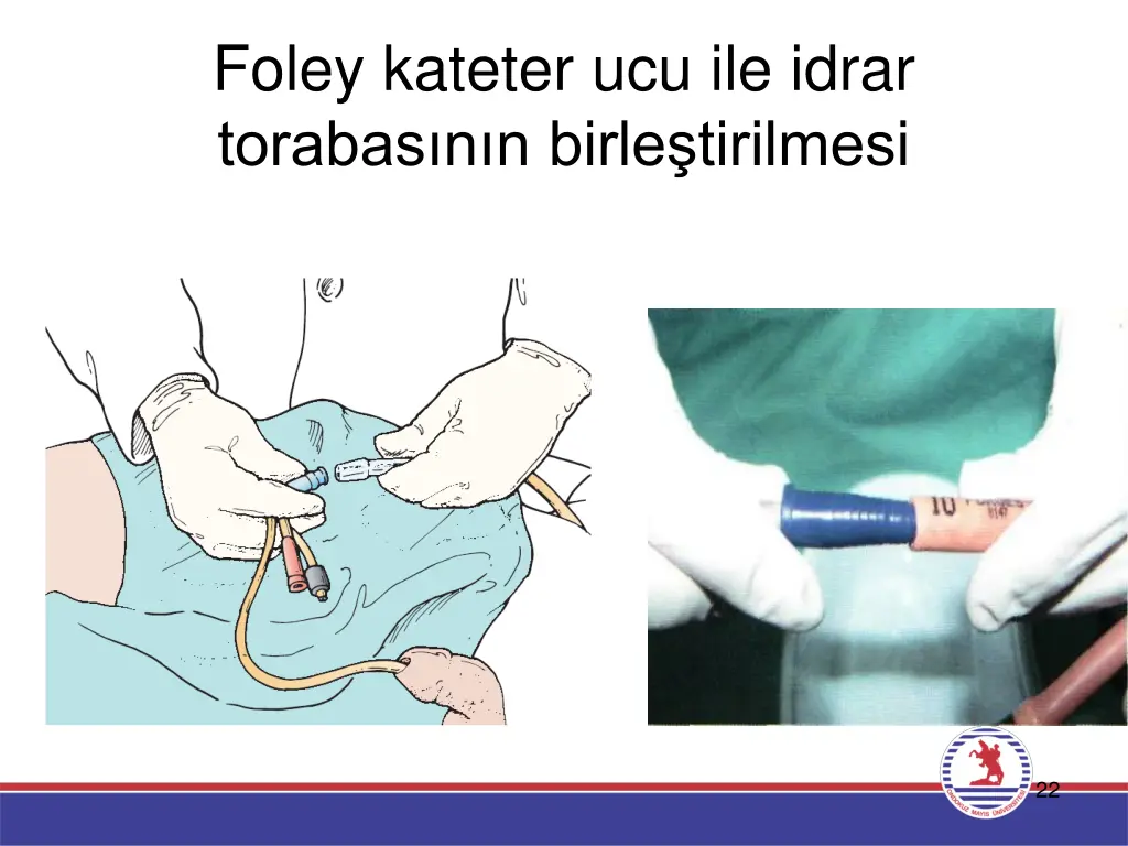 foley kateter ucu ile idrar torabas n n birle