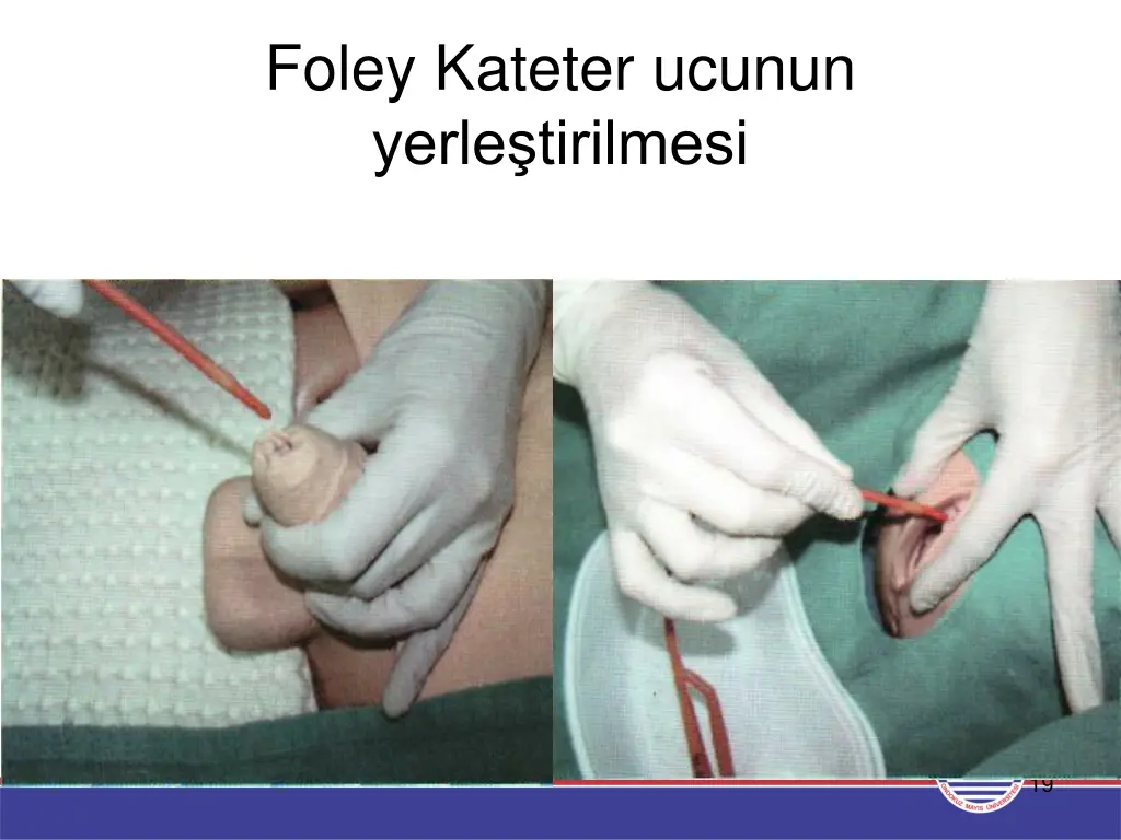 foley kateter ucunun yerle tirilmesi