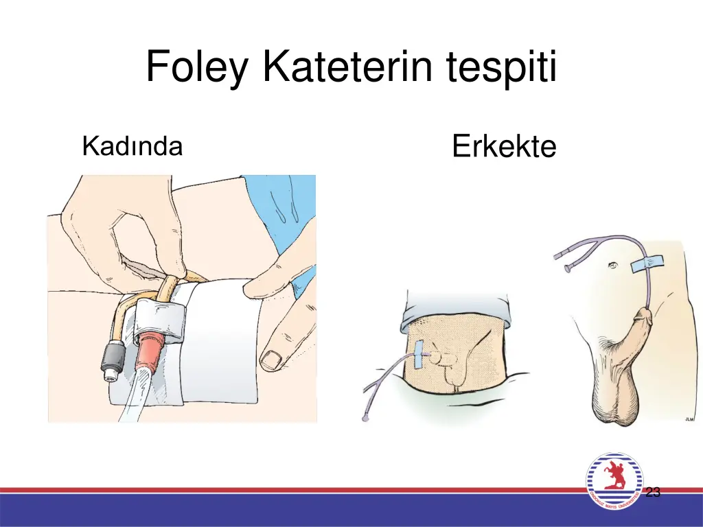 foley kateterin tespiti