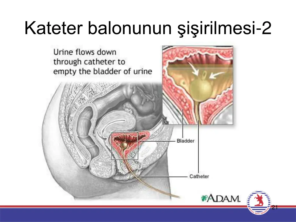 kateter balonunun i irilmesi 2