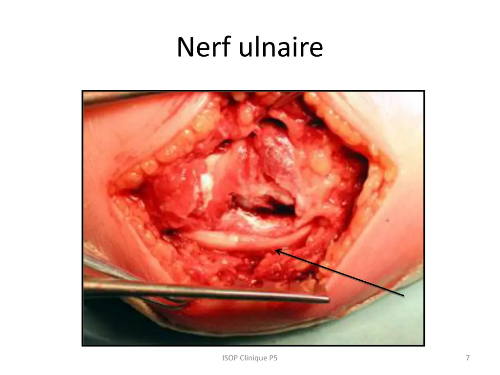 nerf ulnaire