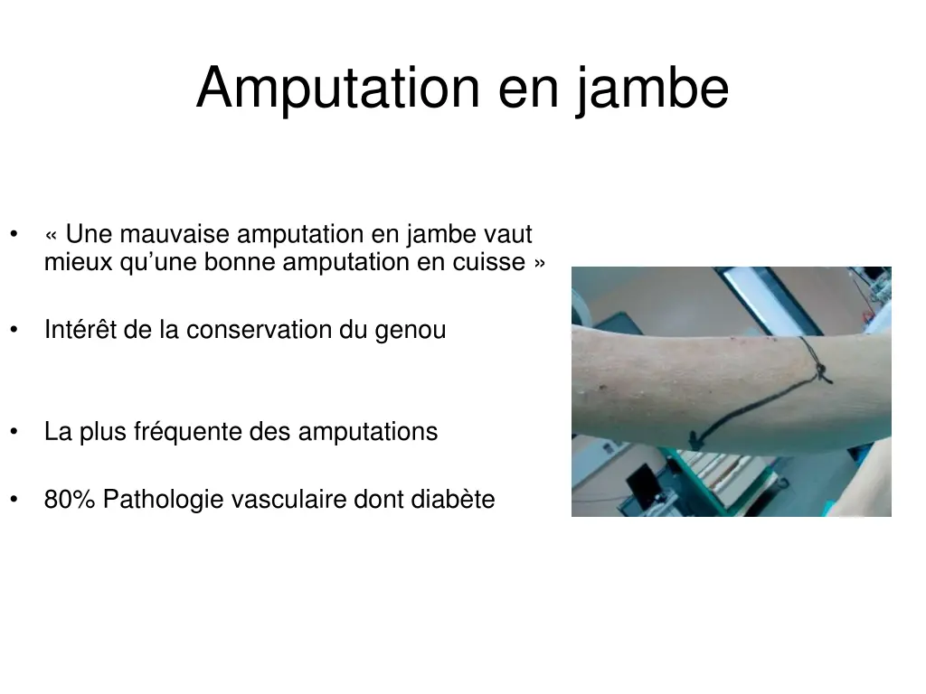 amputation en jambe