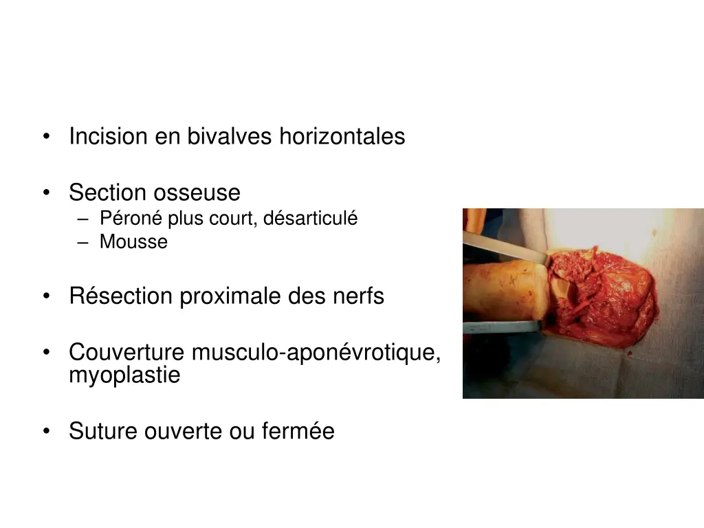 incision en bivalves horizontales