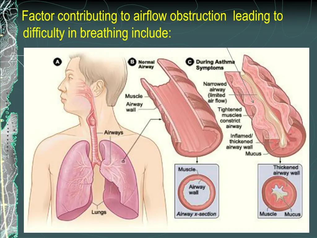 factor contributing to airflow obstruction