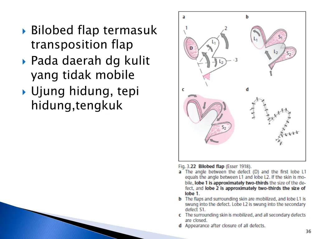 bilobed flap termasuk transposition flap pada