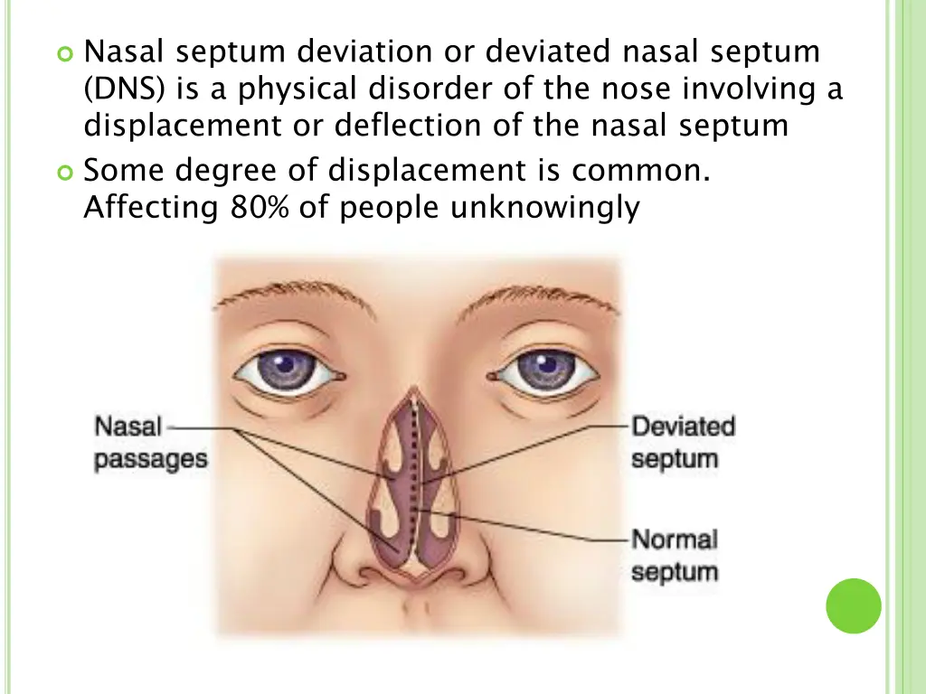 nasal septum deviation or deviated nasal septum