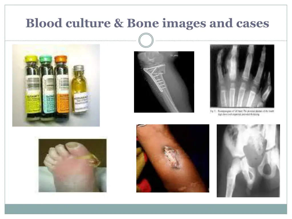 blood culture bone images and cases