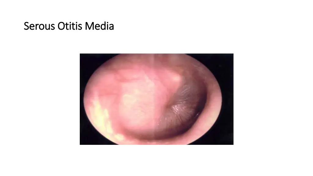 serous otitis media serous otitis media