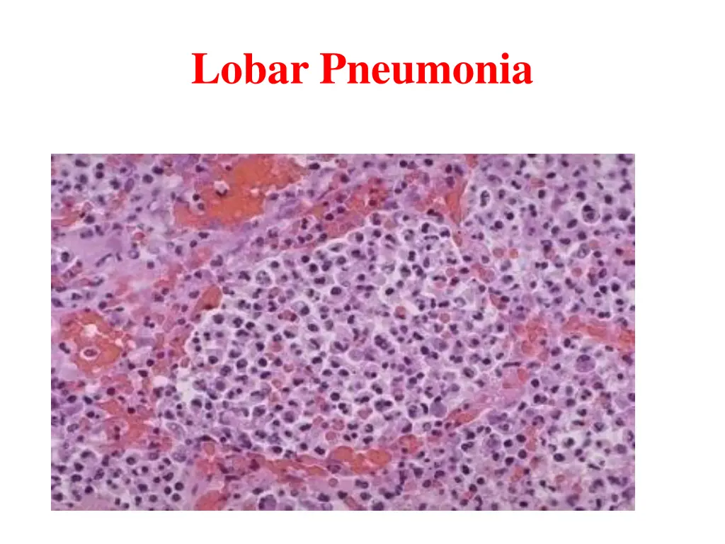lobar pneumonia