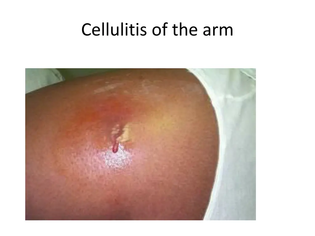 cellulitis of the arm