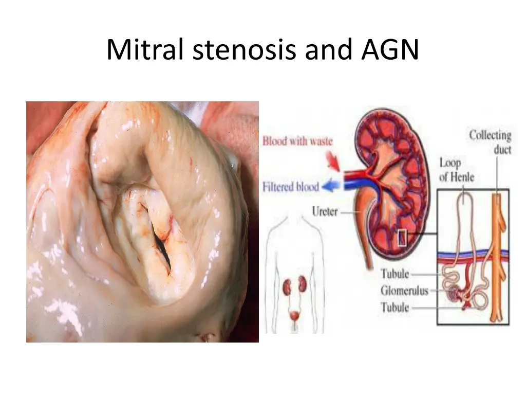 mitral stenosis and agn