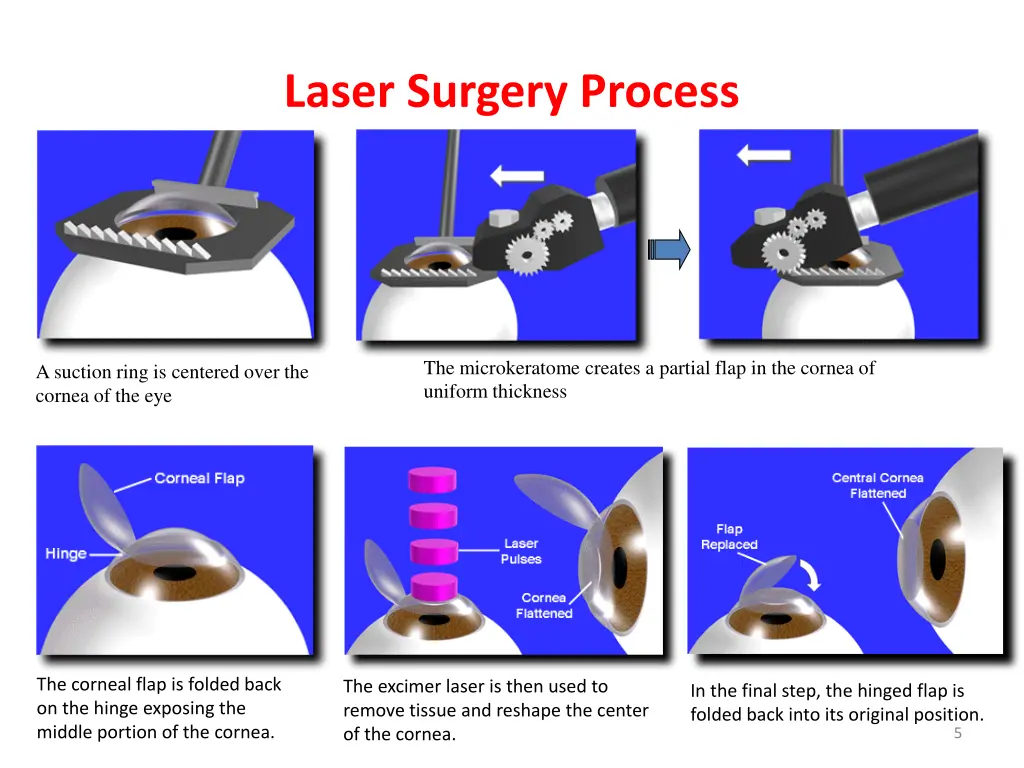 laser surgery process