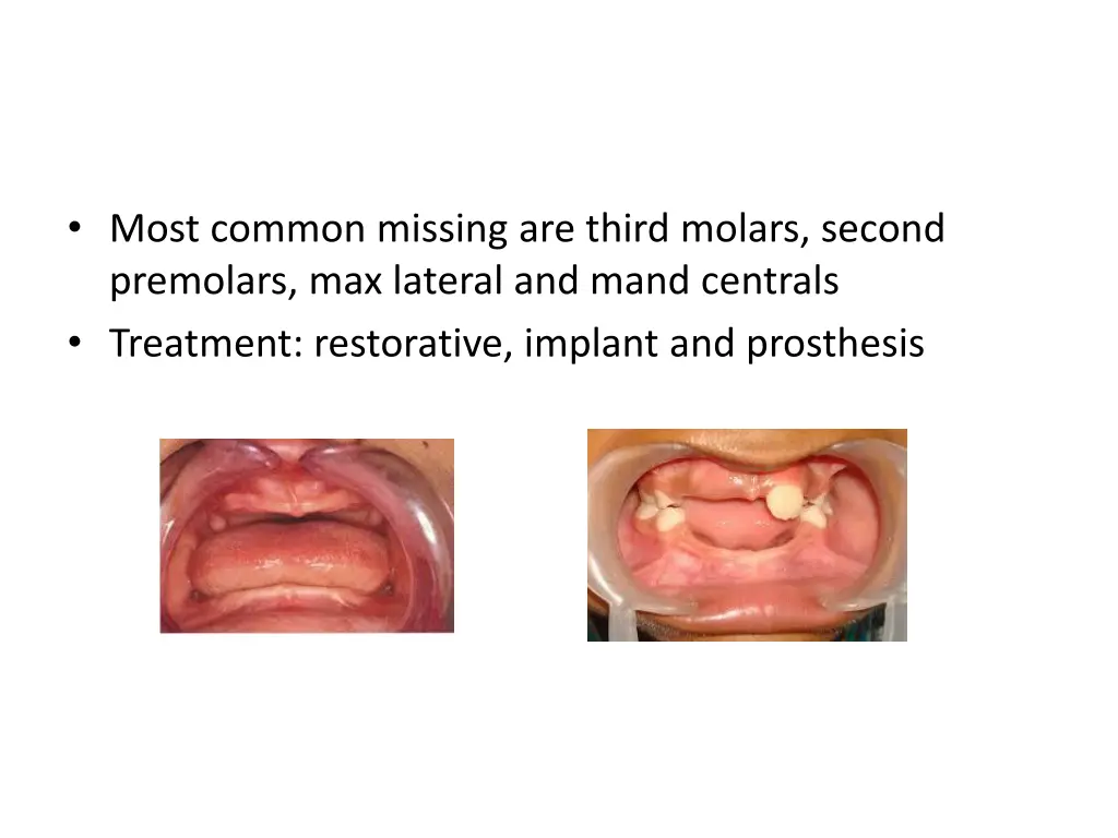 most common missing are third molars second