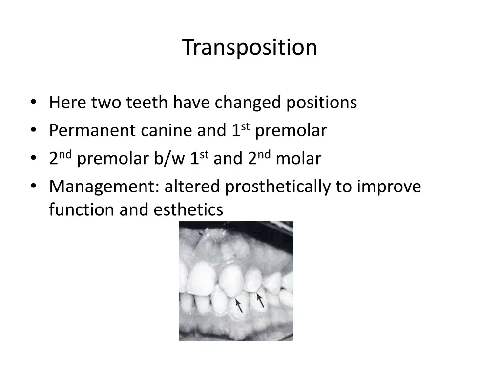 transposition