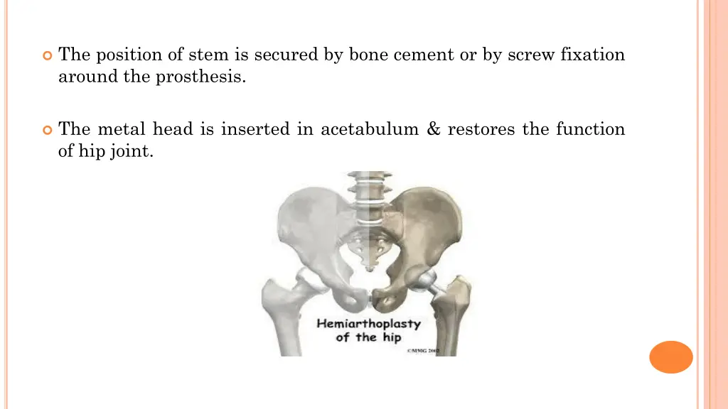 the position of stem is secured by bone cement