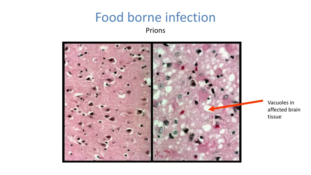 food borne infection prions 1