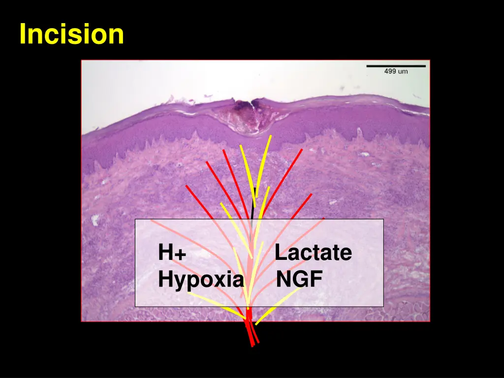incision