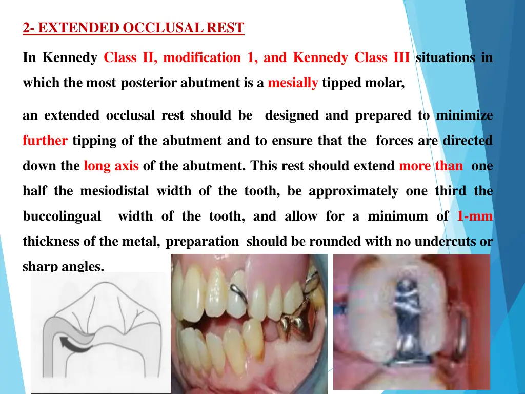 2 extended occlusalrest