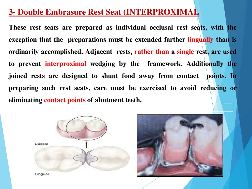 3 double embrasure rest seat interproximal