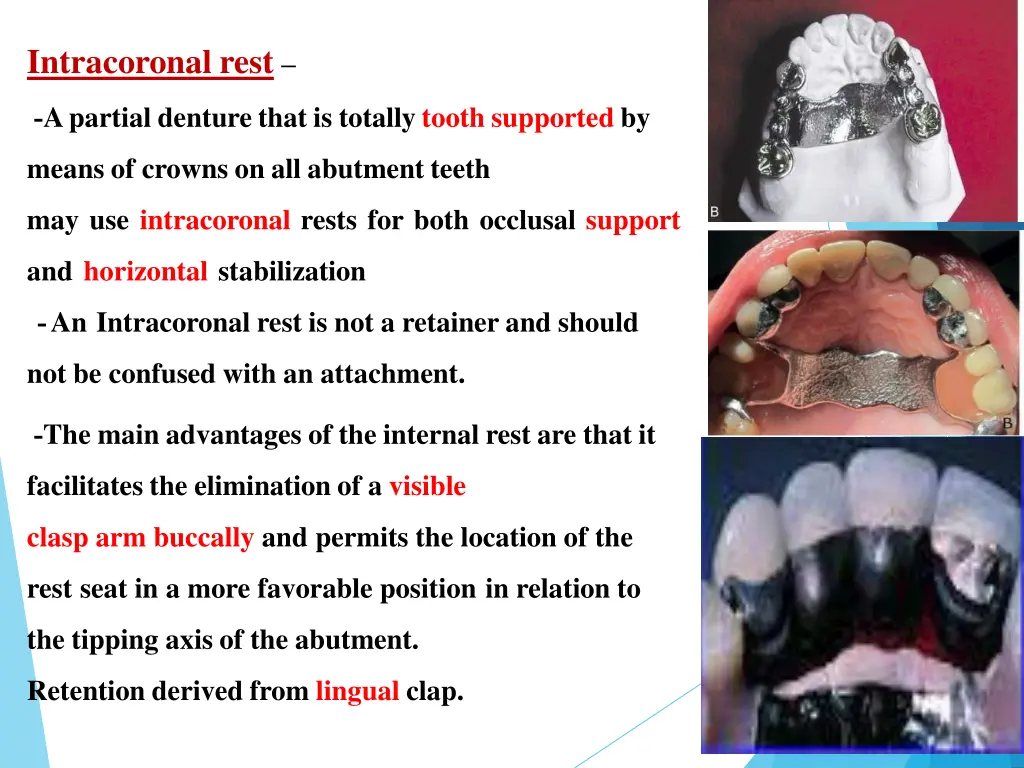 intracoronal rest