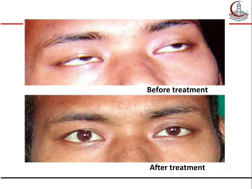 before treatment