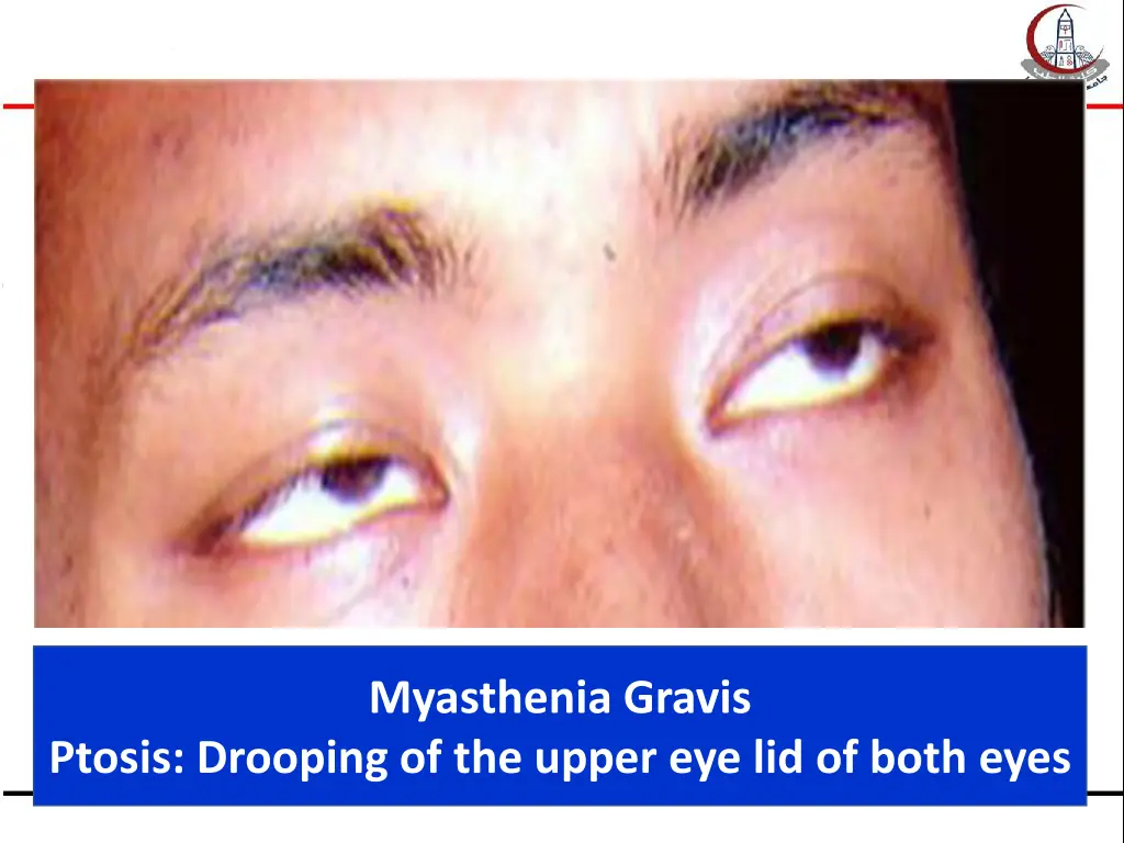 myasthenia gravis