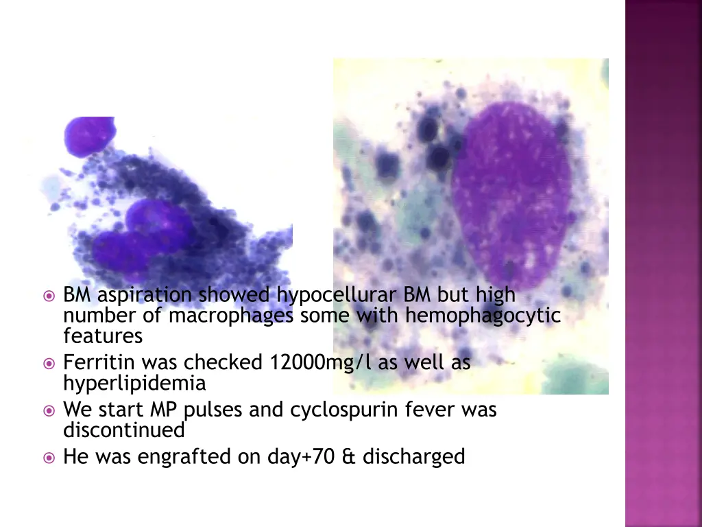 bm aspiration showed hypocellurar bm but high