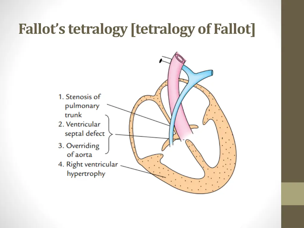 fallot s tetralogy tetralogy of fallot
