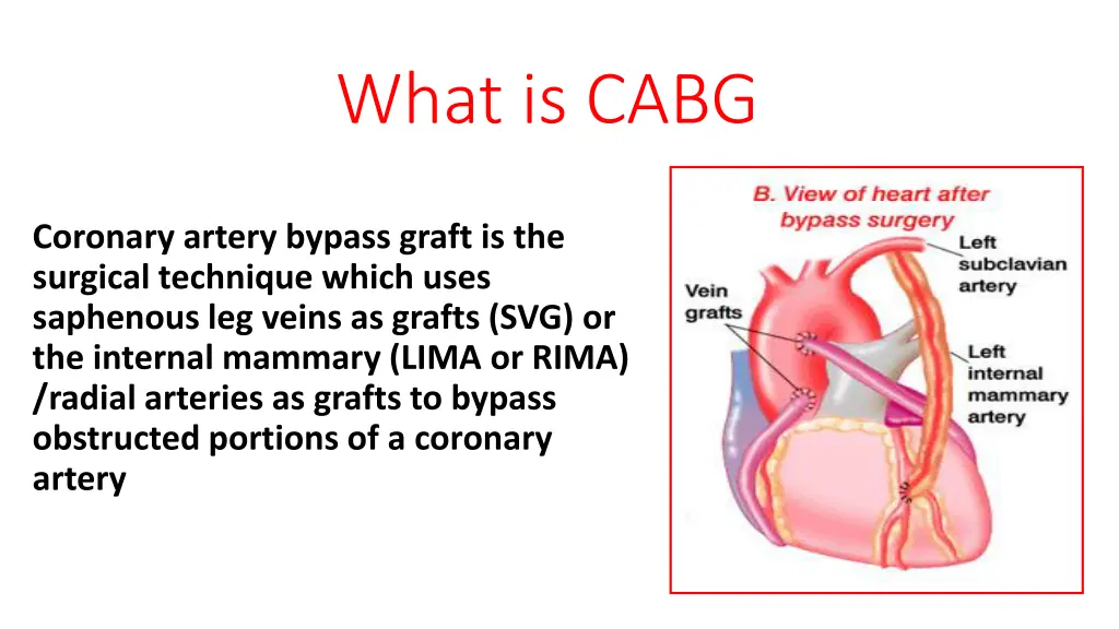 what is cabg