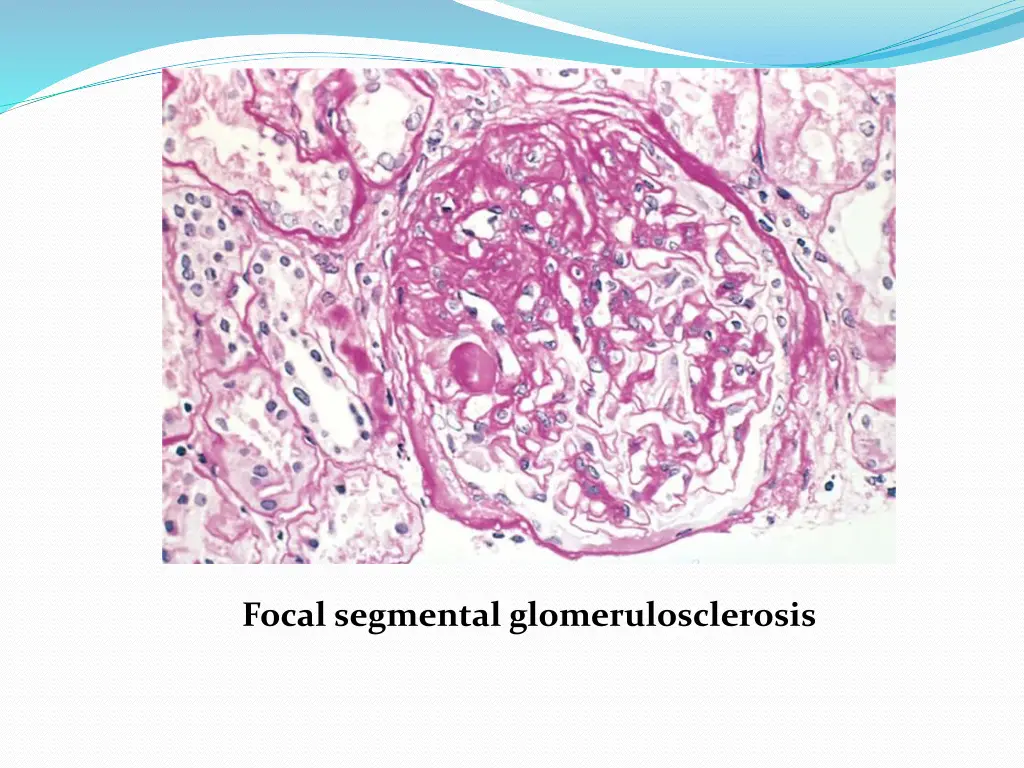 focal segmental glomerulosclerosis 1