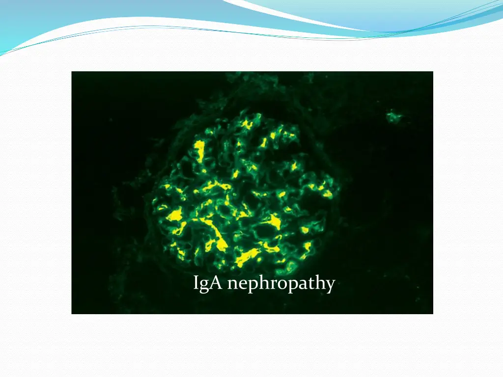 iga nephropathy 1