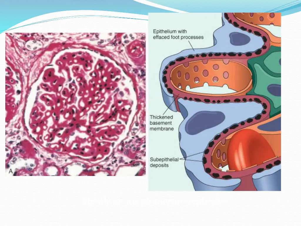 membranous glomerulonephritis 1