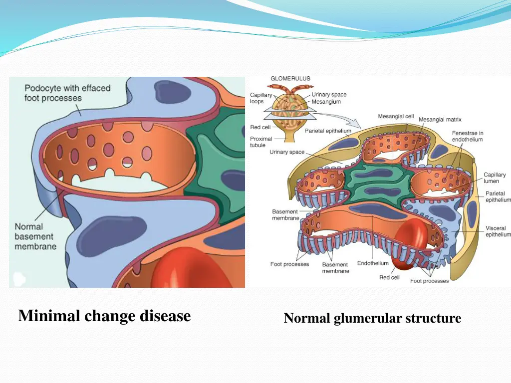 minimal change disease 1