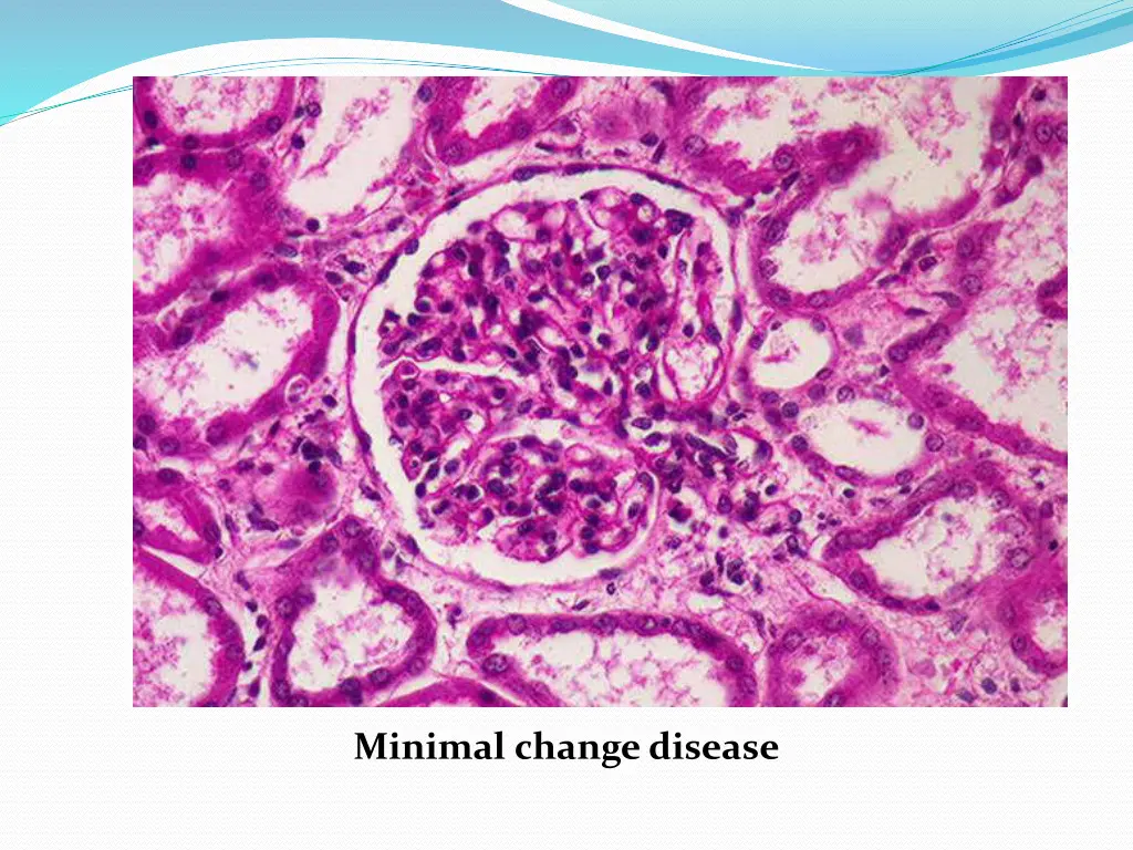 minimal change disease