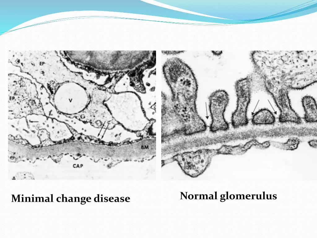 normal glomerulus