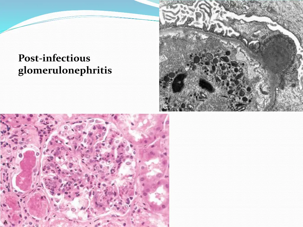 post infectious glomerulonephritis