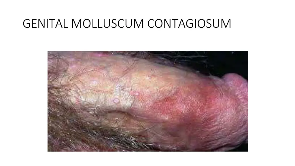 genital molluscum contagiosum