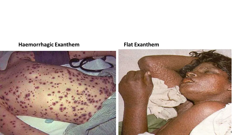haemorrhagicexanthem