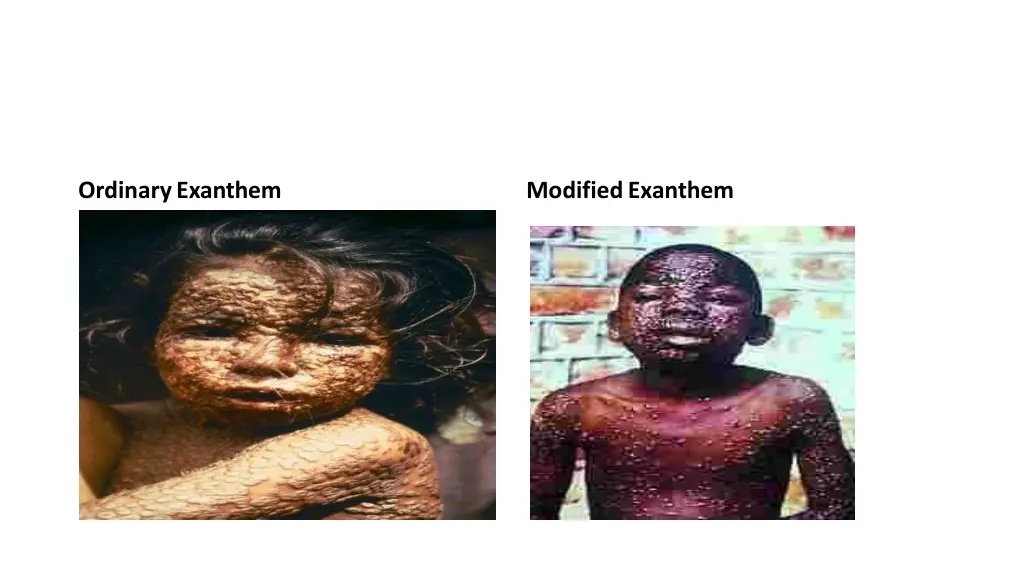 ordinaryexanthem