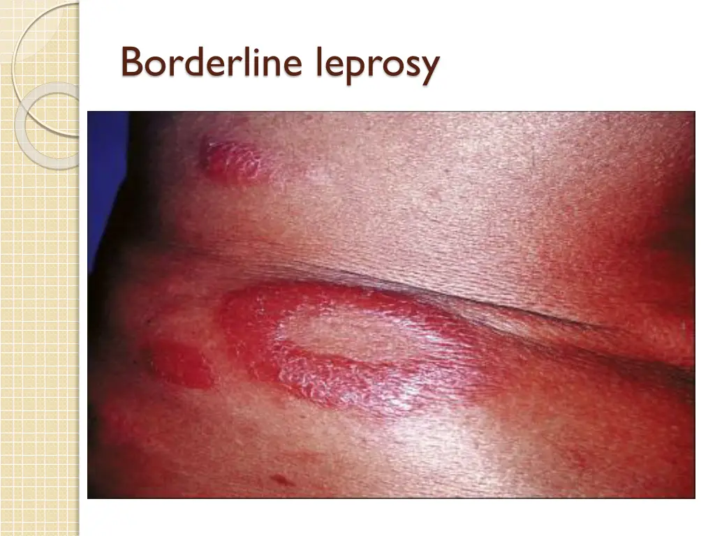 borderline leprosy