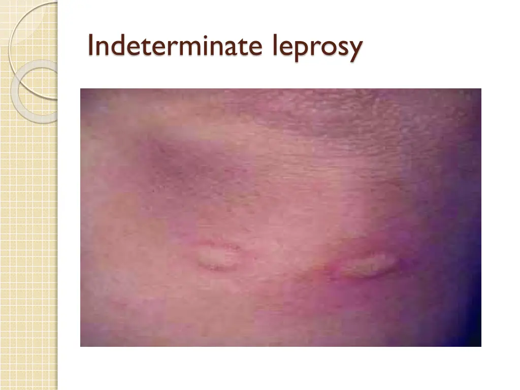 indeterminate leprosy